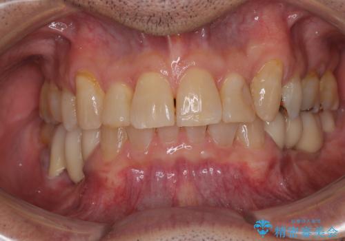 奥歯の欠損と前歯のデコボコを治したい インプラントと矯正治療の総合歯科治療の症例 治療後
