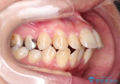 目立たない矯正で口元をすっきりとの治療前