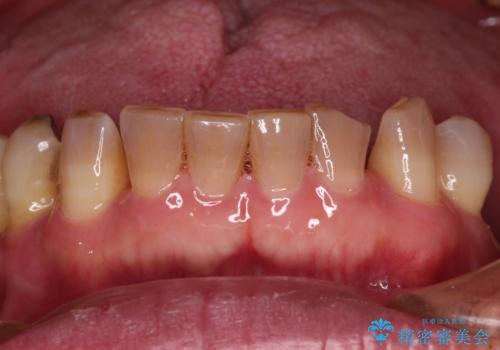 強い咬合力で奥歯がボロボロに インプラント治療による咬合回復と全顎セラミック治療の治療前