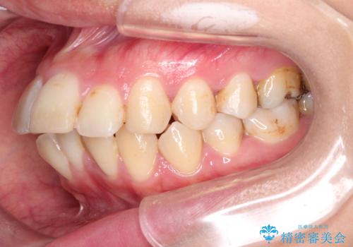 目立たない矯正で口元をすっきりとの治療前