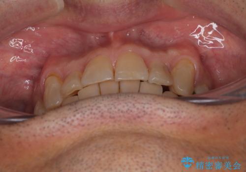 奥歯の欠損と前歯のデコボコを治したい インプラントと矯正治療の総合歯科治療の治療後