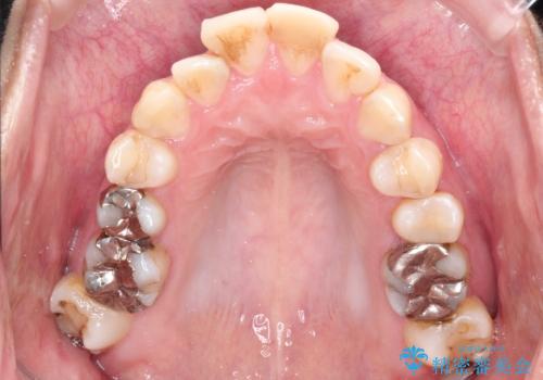 目立たない矯正で口元をすっきりとの治療前