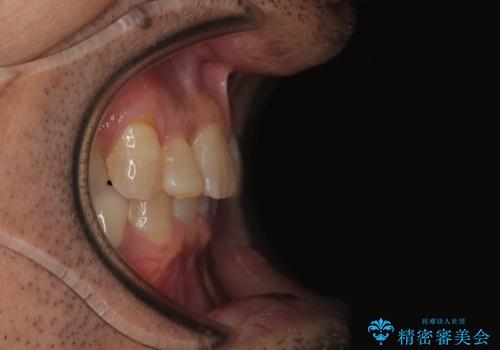 奥歯の欠損と前歯のデコボコを治したい インプラントと矯正治療の総合歯科治療の治療後