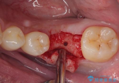 放置した欠損部 奥歯の即時荷重インプラント治療の治療前