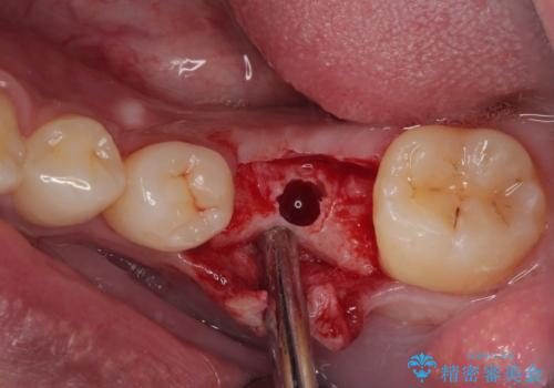 放置した欠損部 奥歯の即時荷重インプラント治療の治療中