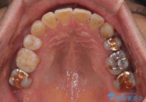 奥歯の欠損と前歯のデコボコを治したい インプラントと矯正治療の総合歯科治療の治療後
