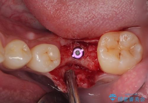 放置した欠損部 奥歯の即時荷重インプラント治療の治療後
