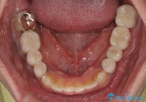 奥歯の欠損と前歯のデコボコを治したい インプラントと矯正治療の総合歯科治療の治療後