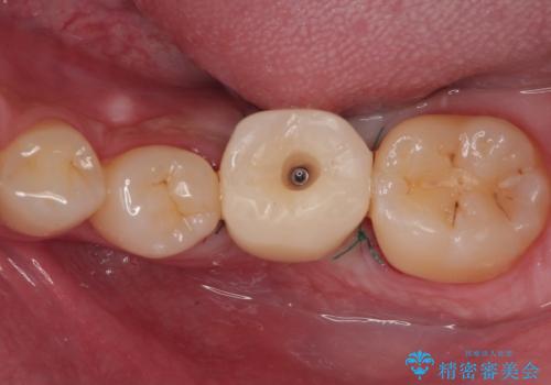 放置した欠損部 奥歯の即時荷重インプラント治療の治療中