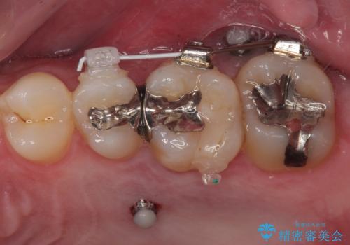 放置した欠損部 奥歯の即時荷重インプラント治療の治療中