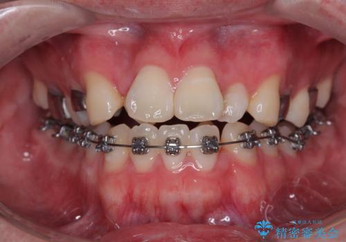 1年でここまで変わる!歯列のがたつきと正中のズレを改善した矯正治療(メタルブラケット×MARPE)の治療中