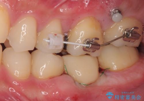 放置した欠損部 奥歯の即時荷重インプラント治療の治療中