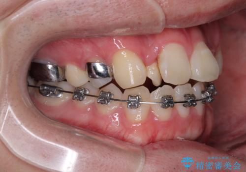 1年でここまで変わる!歯列のがたつきと正中のズレを改善した矯正治療(メタルブラケット×MARPE)の治療中