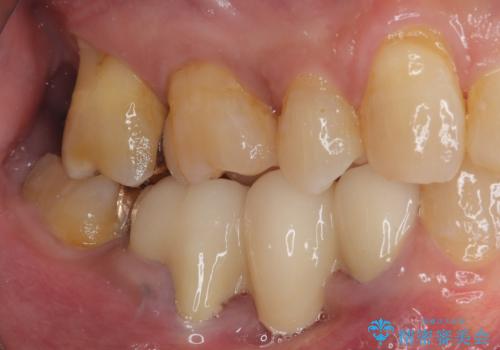 奥歯の欠損と前歯のデコボコを治したい インプラントと矯正治療の総合歯科治療の治療後
