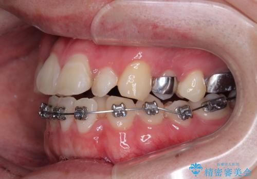 1年でここまで変わる!歯列のがたつきと正中のズレを改善した矯正治療(メタルブラケット×MARPE)の治療中