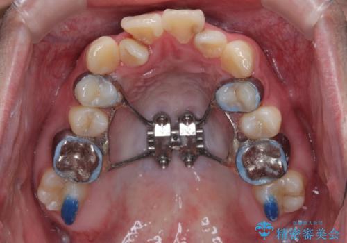 1年でここまで変わる!歯列のがたつきと正中のズレを改善した矯正治療(メタルブラケット×MARPE)の治療中