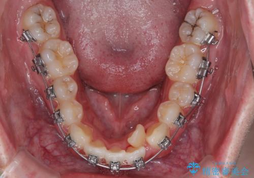 1年でここまで変わる!歯列のがたつきと正中のズレを改善した矯正治療(メタルブラケット×MARPE)の治療中