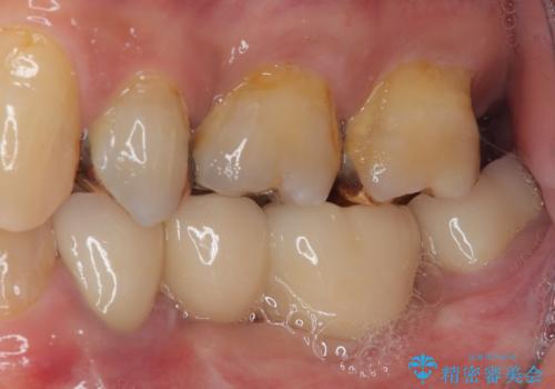 奥歯の欠損と前歯のデコボコを治したい インプラントと矯正治療の総合歯科治療の治療後