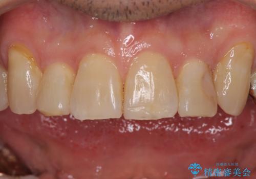 奥歯の欠損と前歯のデコボコを治したい インプラントと矯正治療の総合歯科治療の治療後