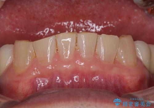 奥歯の欠損と前歯のデコボコを治したい インプラントと矯正治療の総合歯科治療の治療後