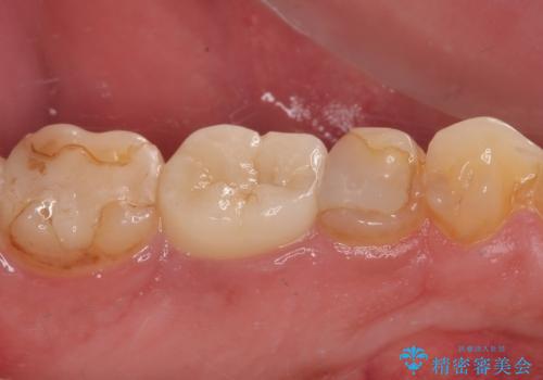 歯肉が腫れてズキズキする　奥歯の根管治療の治療後