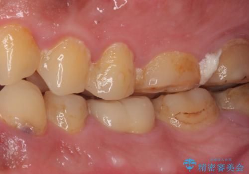 歯肉が腫れてズキズキする　奥歯の根管治療の治療後
