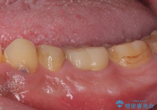 歯肉が腫れてズキズキする　奥歯の根管治療の治療後
