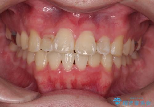 1年でここまで変わる!歯列のがたつきと正中のズレを改善した矯正治療(メタルブラケット×MARPE)の症例 治療後