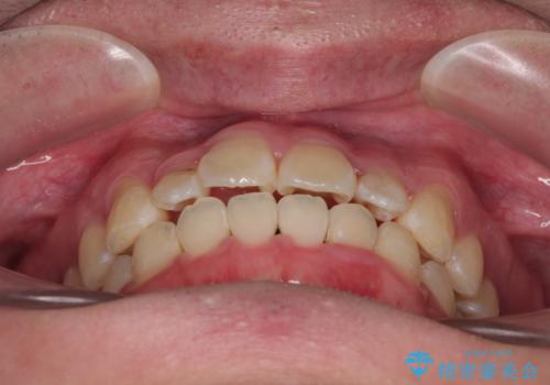 1年でここまで変わる!歯列のがたつきと正中のズレを改善した矯正治療(メタルブラケット×MARPE)の治療後