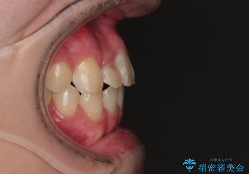 1年でここまで変わる!歯列のがたつきと正中のズレを改善した矯正治療(メタルブラケット×MARPE)の治療後