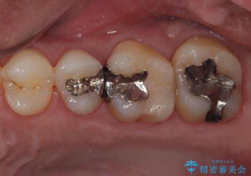 放置した欠損部 奥歯の即時荷重インプラント治療の治療後