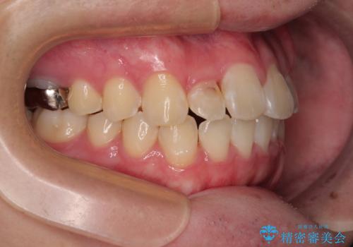 1年でここまで変わる!歯列のがたつきと正中のズレを改善した矯正治療(メタルブラケット×MARPE)の治療後