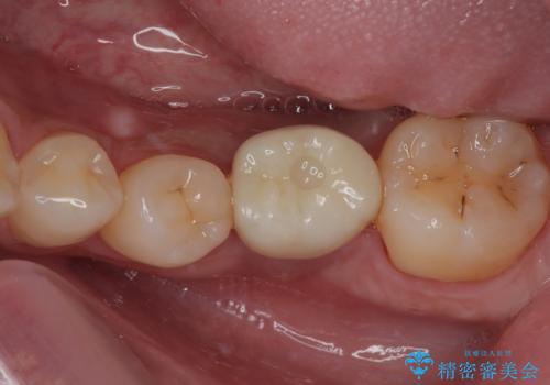 放置した欠損部 奥歯の即時荷重インプラント治療の治療後