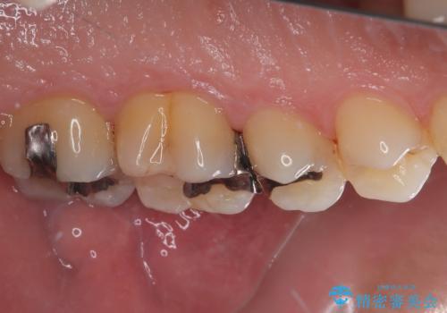 放置した欠損部 奥歯の即時荷重インプラント治療の治療後