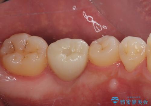 放置した欠損部 奥歯の即時荷重インプラント治療の治療後