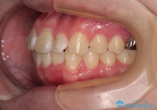 1年でここまで変わる!歯列のがたつきと正中のズレを改善した矯正治療(メタルブラケット×MARPE)の治療後