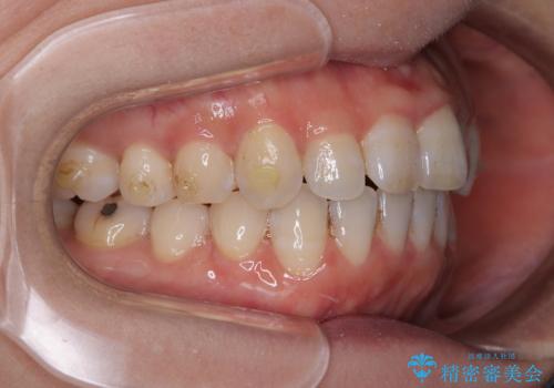 【モニター】飛び出した上顎前歯 補助装置を併用したインビザライン矯正治療の治療中