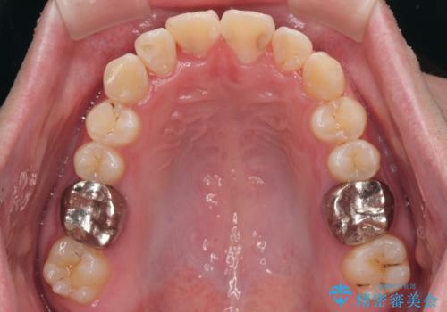 1年でここまで変わる!歯列のがたつきと正中のズレを改善した矯正治療(メタルブラケット×MARPE)の治療後