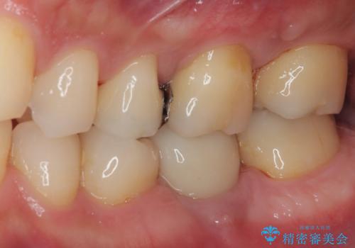 放置した欠損部 奥歯の即時荷重インプラント治療の症例 治療後