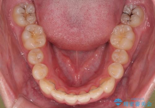 1年でここまで変わる!歯列のがたつきと正中のズレを改善した矯正治療(メタルブラケット×MARPE)の治療後