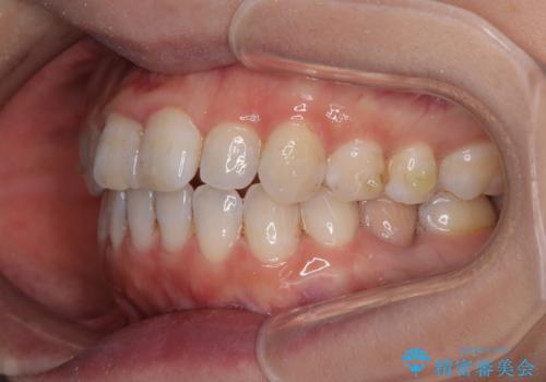 【モニター】飛び出した上顎前歯 補助装置を併用したインビザライン矯正治療の治療中