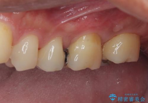 放置した欠損部 奥歯の即時荷重インプラント治療の治療後