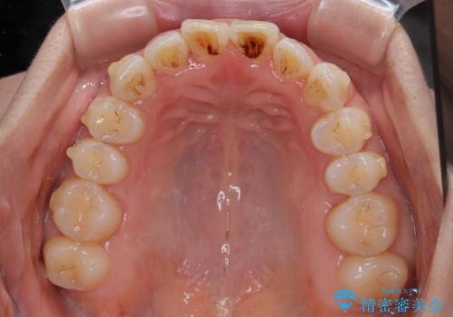 【モニター】飛び出した上顎前歯 補助装置を併用したインビザライン矯正治療の治療中