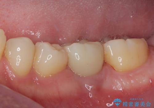 放置した欠損部 奥歯の即時荷重インプラント治療の治療後