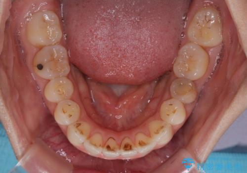 【モニター】飛び出した上顎前歯 補助装置を併用したインビザライン矯正治療の治療中