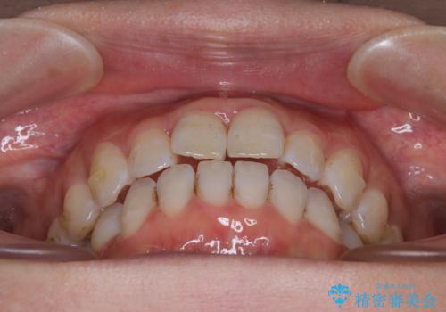 【モニター】飛び出した上顎前歯 補助装置を併用したインビザライン矯正治療の治療中