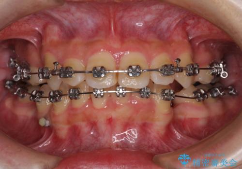 気になる八重歯 ワイヤー装置での抜歯矯正の治療中