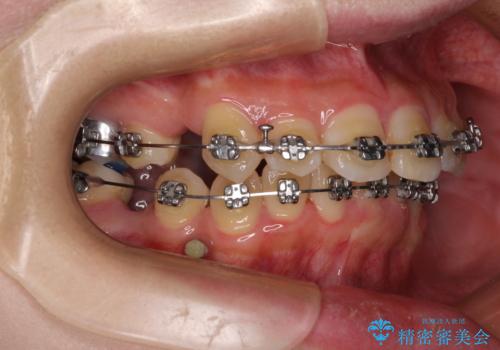 気になる八重歯 ワイヤー装置での抜歯矯正の治療中