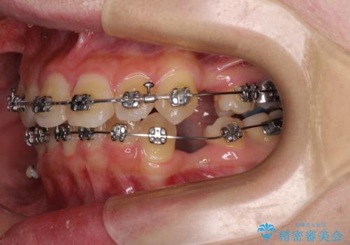 気になる八重歯 ワイヤー装置での抜歯矯正の治療中