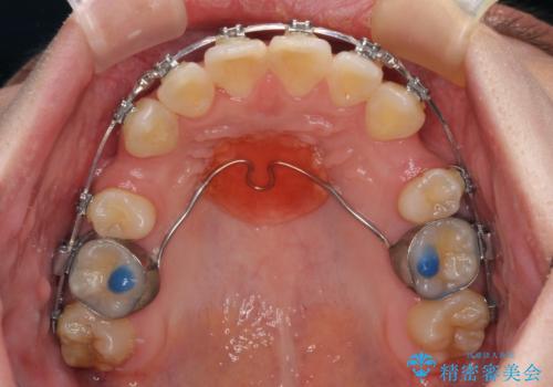 気になる八重歯 ワイヤー装置での抜歯矯正の治療中
